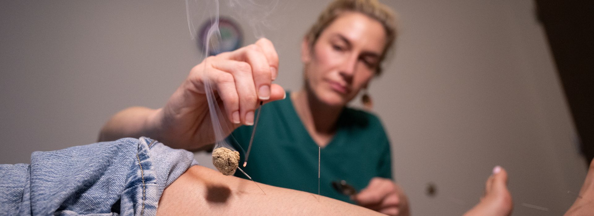 Close up of acupuncture needle. 