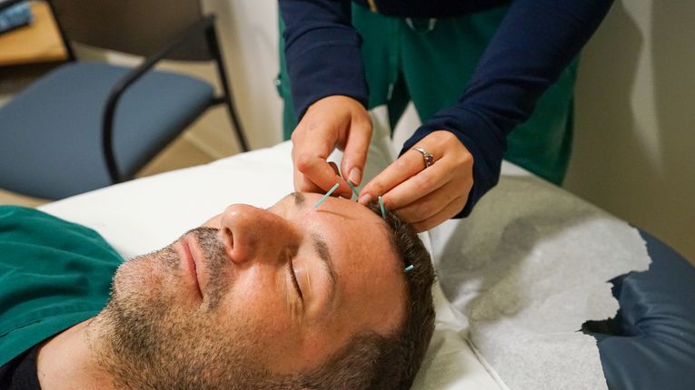 Rob Halpin gets acupuncture treatment in his face.